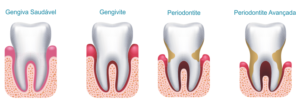 Leia mais sobre o artigo PERIODONTIA