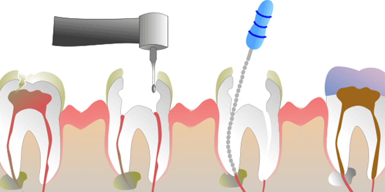 Leia mais sobre o artigo ENDODONTIA